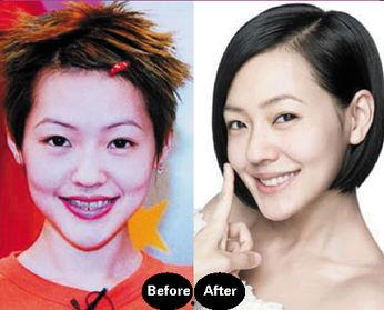 明星为什么带牙套